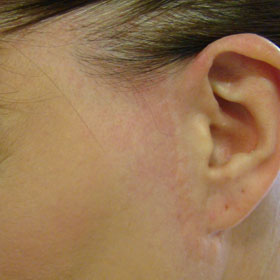 scar removal